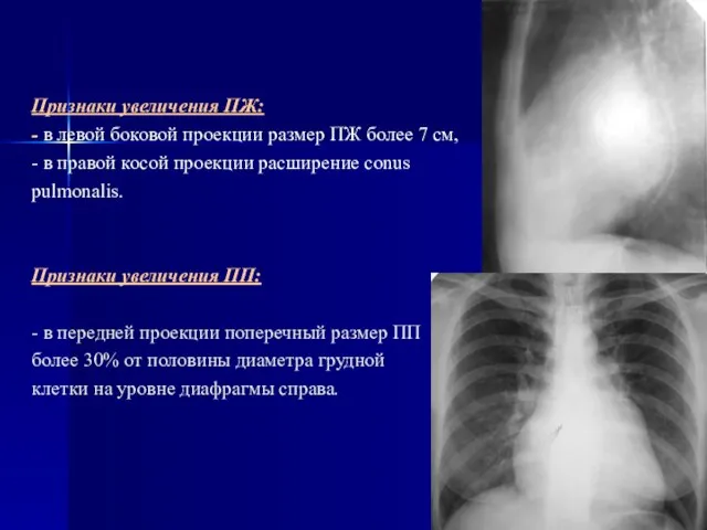 Признаки увеличения ПЖ: - в левой боковой проекции размер ПЖ более 7