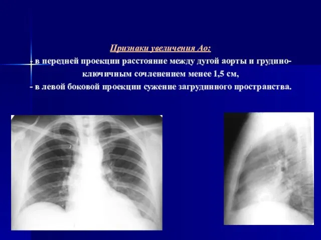 Признаки увеличения Ao: - в передней проекции расстояние между дугой аорты и