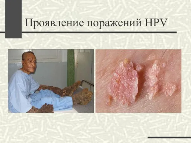 Проявление поражений HPV