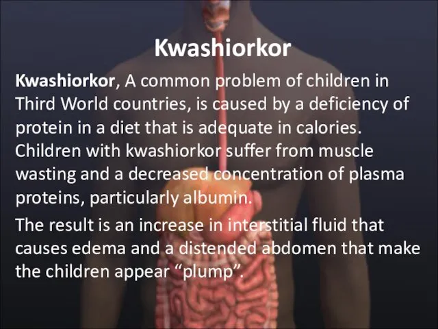 Kwashiorkor Kwashiorkor, A common problem of children in Third World countries, is