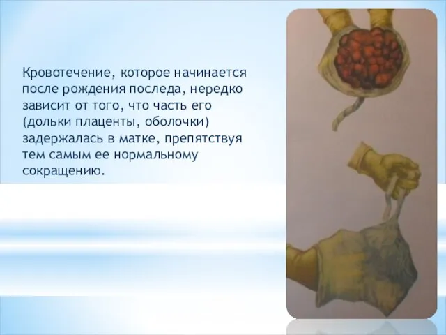 Кровотечение, которое начи­нается после рождения последа, нередко зависит от того, что часть