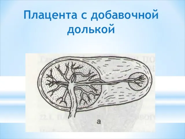 Плацента с добавочной долькой