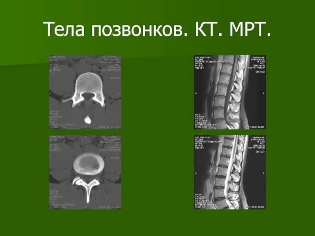 Тела позвонков. КТ. МРТ.