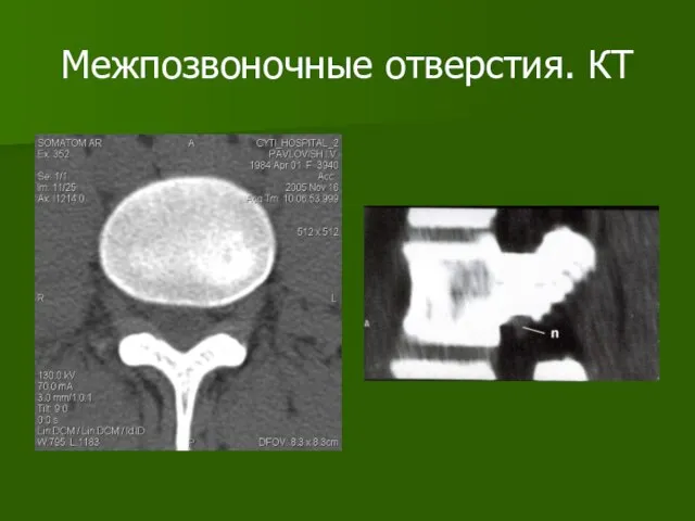 Межпозвоночные отверстия. КТ