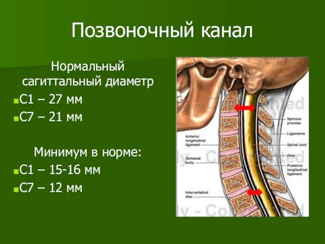 Позвоночный канал Нормальный сагиттальный диаметр С1 – 27 мм С7 – 21