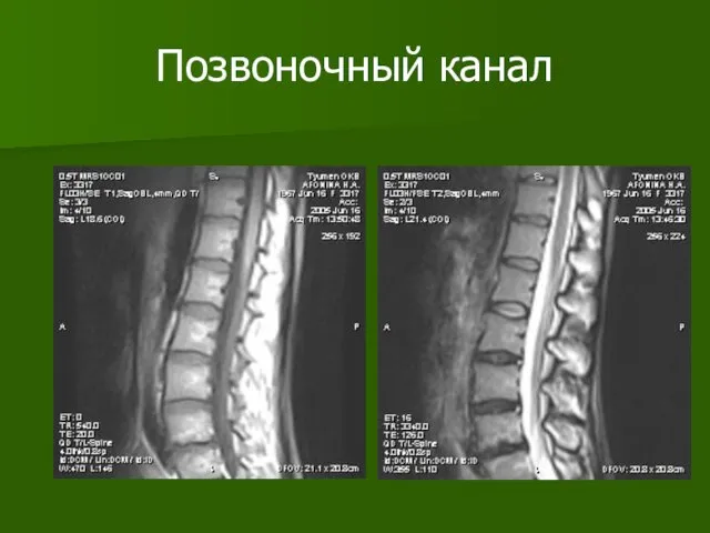 Позвоночный канал