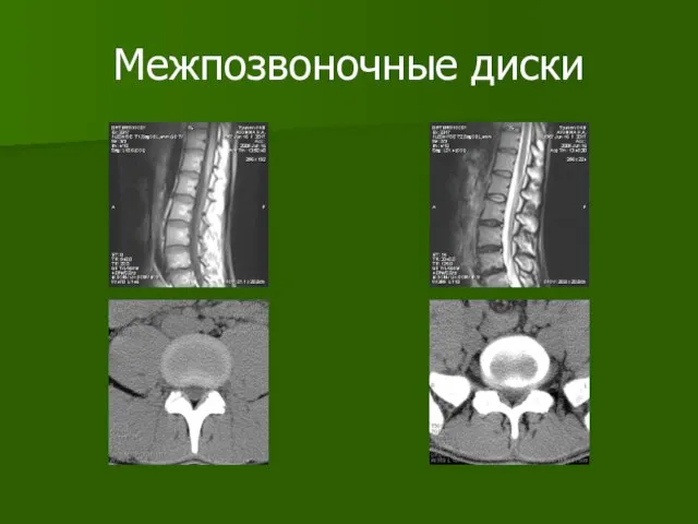 Межпозвоночные диски