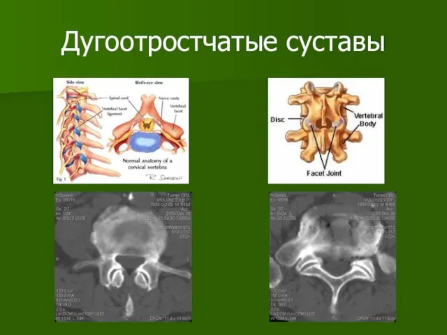 Дугоотростчатые суставы