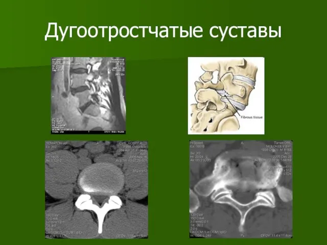 Дугоотростчатые суставы