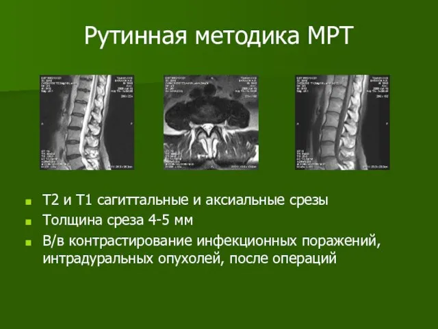 Рутинная методика МРТ Т2 и Т1 сагиттальные и аксиальные срезы Толщина среза