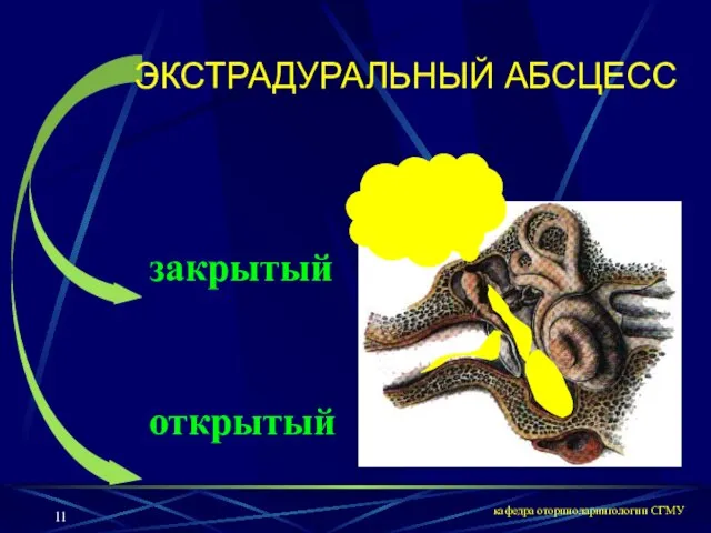 кафедра оториноларингологии СГМУ закрытый открытый ЭКСТРАДУРАЛЬНЫЙ АБСЦЕСС