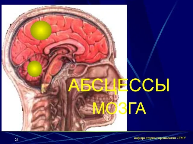 кафедра оториноларингологии СГМУ АБСЦЕССЫ МОЗГА