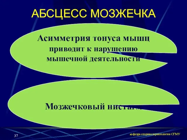 кафедра оториноларингологии СГМУ Мозжечковый нистагм АБСЦЕСС МОЗЖЕЧКА Асимметрия тонуса мышц приводит к нарушению мышечной деятельности