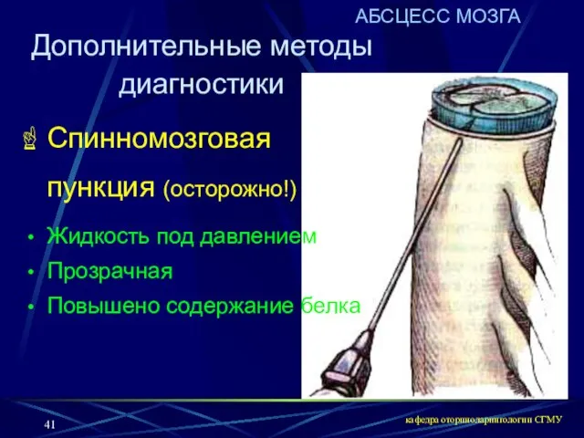 кафедра оториноларингологии СГМУ Дополнительные методы диагностики АБСЦЕСС МОЗГА Спинномозговая пункция (осторожно!) Жидкость