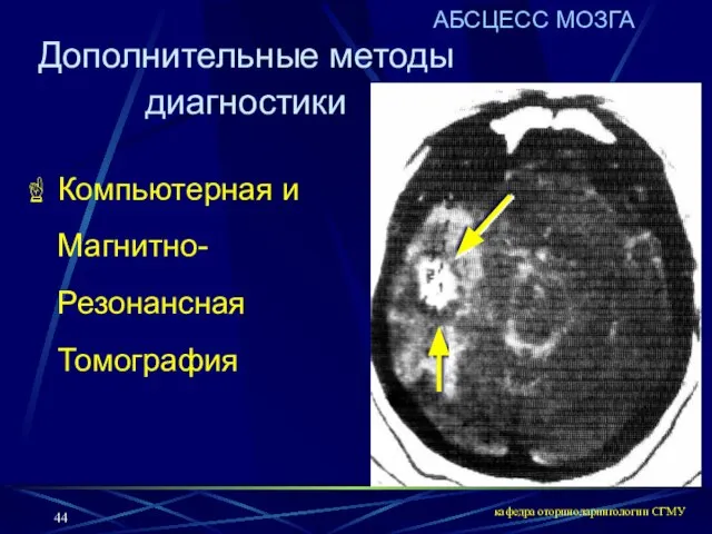 кафедра оториноларингологии СГМУ АБСЦЕСС МОЗГА Компьютерная и Магнитно-Резонансная Томография Дополнительные методы диагностики