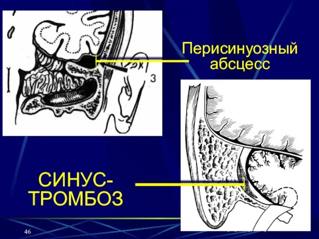 кафедра оториноларингологии СГМУ Перисинуозный абсцесс СИНУС-ТРОМБОЗ