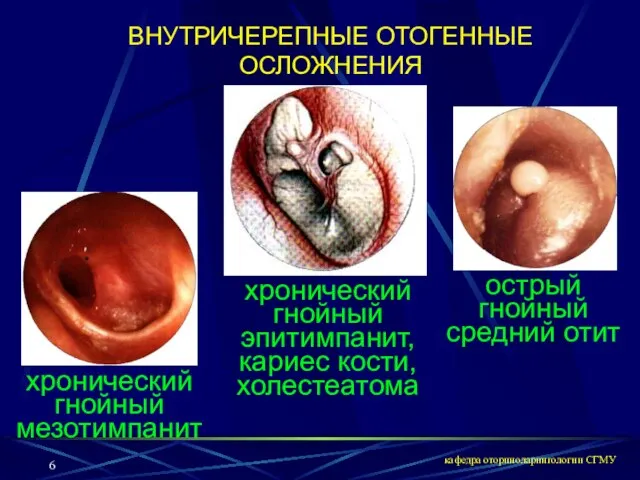 кафедра оториноларингологии СГМУ хронический гнойный мезотимпанит хронический гнойный эпитимпанит, кариес кости, холестеатома