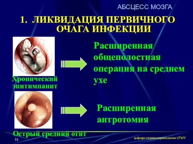 кафедра оториноларингологии СГМУ ЛИКВИДАЦИЯ ПЕРВИЧНОГО ОЧАГА ИНФЕКЦИИ Расширенная антротомия Расширенная общеполостная операция