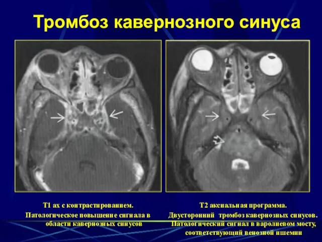 Тромбоз кавернозного синуса Т1 ах с контрастированием. Патологическое повышение сигнала в области