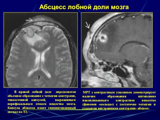 Абсцесс лобной доли мозга МРТ с контрастным усилением демонстрирует наличие образования интенсивно