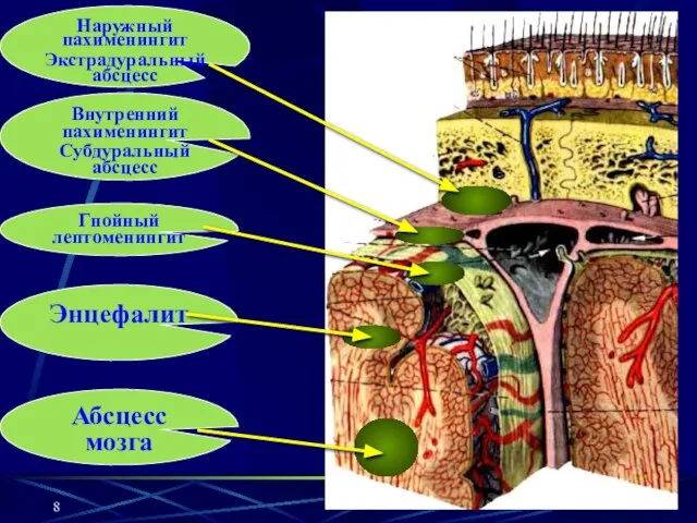 кафедра оториноларингологии СГМУ Наружный пахименингит Экстрадуральный абсцесс Внутренний пахименингит Субдуральный абсцесс Гнойный лептоменингит Энцефалит Абсцесс мозга