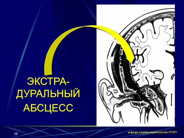 кафедра оториноларингологии СГМУ ЭКСТРА- ДУРАЛЬНЫЙ АБСЦЕСС