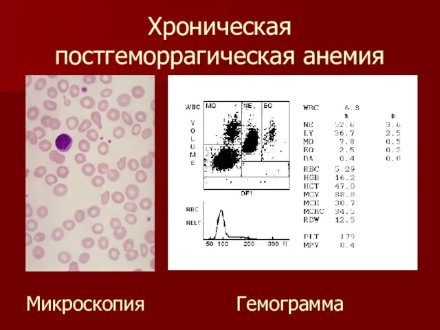 Хроническая постгеморрагическая анемия Микроскопия Гемограмма