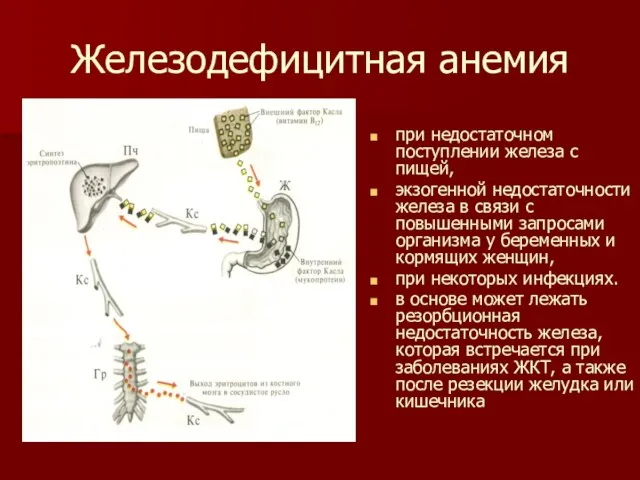 Железодефицитная анемия при недостаточном поступлении железа с пищей, экзогенной недостаточности железа в