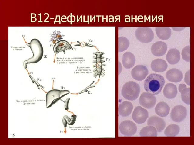 В12-дефицитная анемия