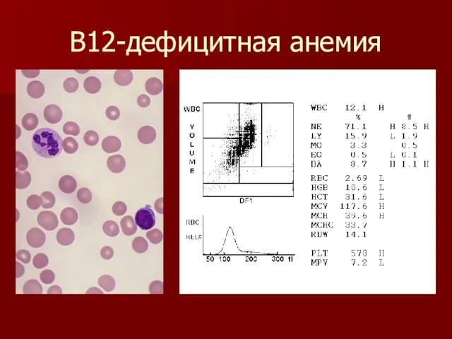 В12-дефицитная анемия