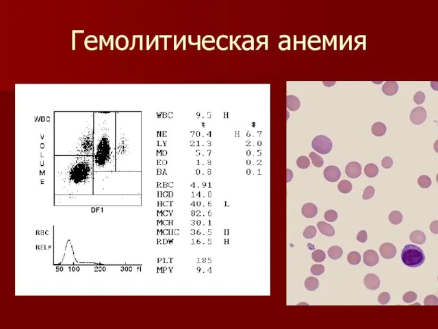 Гемолитическая анемия