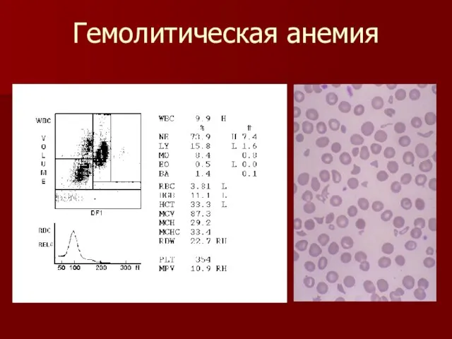 Гемолитическая анемия