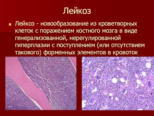 Лейкоз Лейкоз - новообразование из кроветворных клеток с поражением костного мозга в