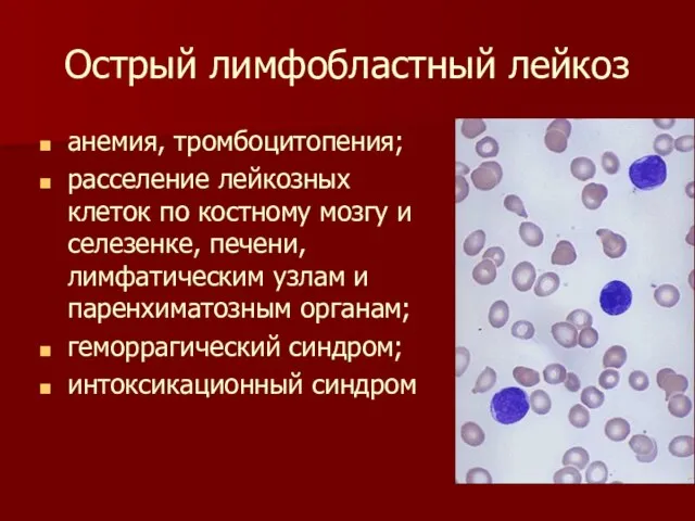 Острый лимфобластный лейкоз анемия, тромбоцитопения; расселение лейкозных клеток по костному мозгу и