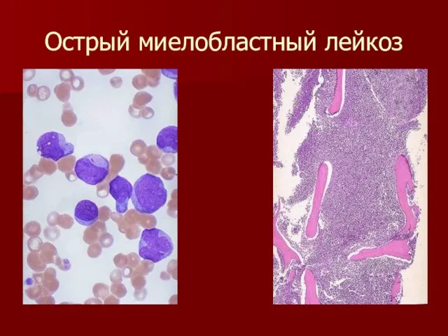 Острый миелобластный лейкоз