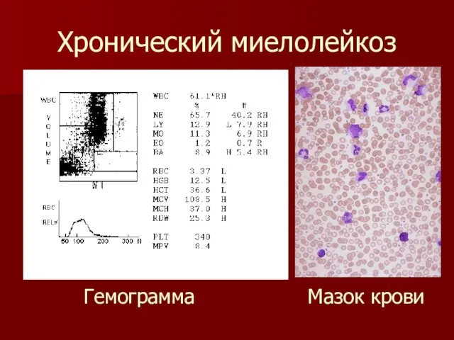 Хронический миелолейкоз Гемограмма Мазок крови