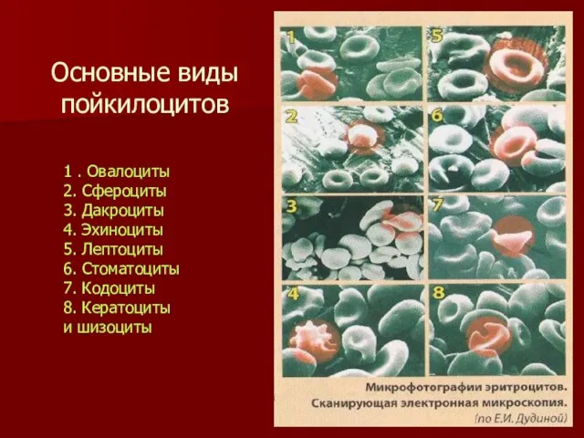 Основные виды пойкилоцитов 1 . Овалоциты 2. Сфероциты 3. Дакроциты 4. Эхиноциты