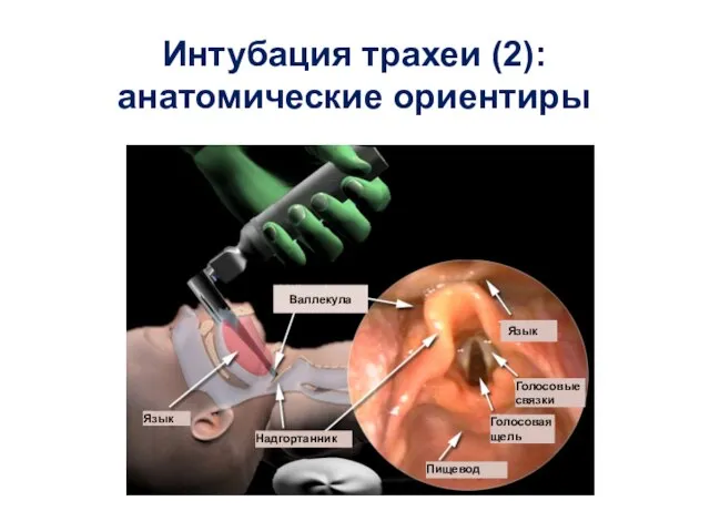 Интубация трахеи (2): анатомические ориентиры Валлекула Язык Язык Голосовые связки Надгортанник Голосовая щель Пищевод Валлекула