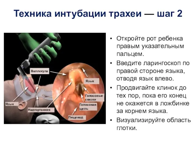 Техника интубации трахеи — шаг 2 Откройте рот ребенка правым указательным пальцем.