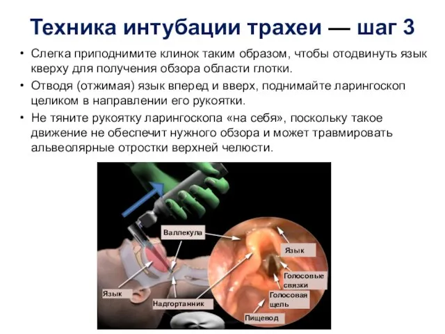 Техника интубации трахеи — шаг 3 Слегка приподнимите клинок таким образом, чтобы