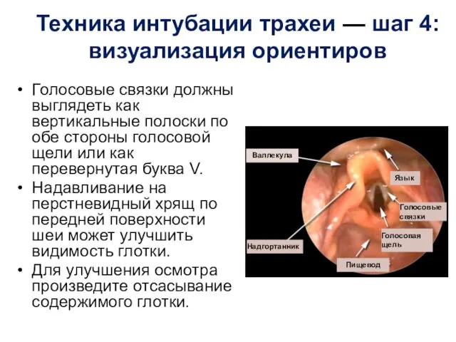 Техника интубации трахеи — шаг 4: визуализация ориентиров Голосовые связки должны выглядеть