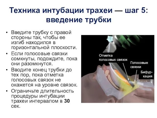 Техника интубации трахеи — шаг 5: введение трубки Введите трубку с правой