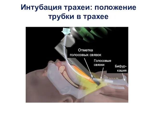 Интубация трахеи: положение трубки в трахее Отметка голосовых связок Голосовые связки Бифур-кация