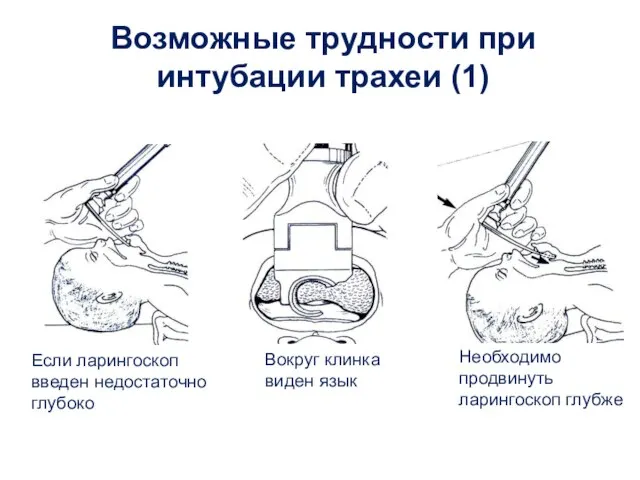 Возможные трудности при интубации трахеи (1) Если ларингоскоп введен недостаточно глубоко Вокруг