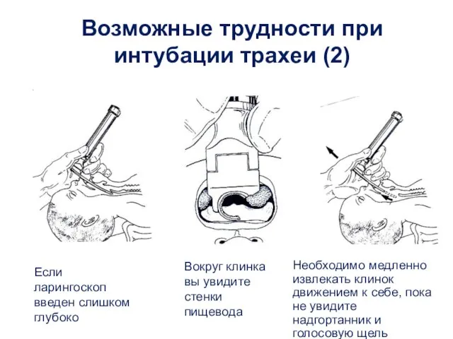 Возможные трудности при интубации трахеи (2) Если ларингоскоп введен слишком глубоко Вокруг