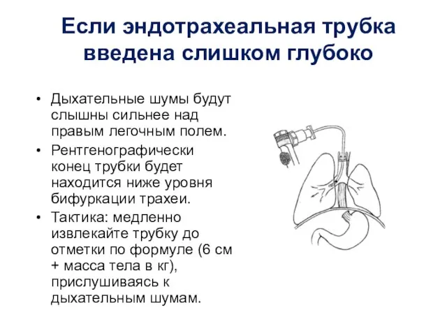 Если эндотрахеальная трубка введена слишком глубоко Дыхательные шумы будут слышны сильнее над