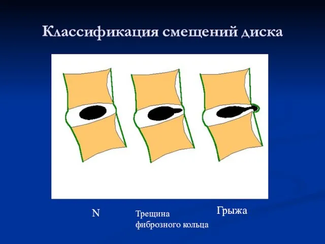 Классификация смещений диска N N N Трещина фиброзного кольца Грыжа