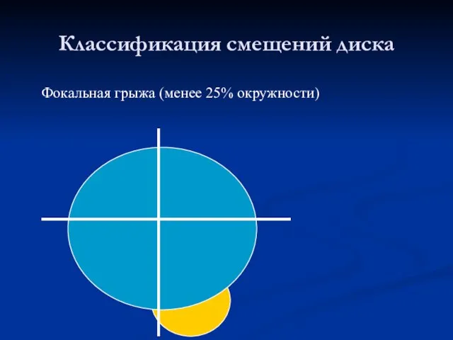 Классификация смещений диска Фокальная грыжа (менее 25% окружности)