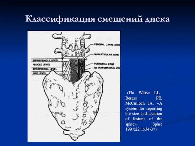 Классификация смещений диска (По Wiltse LL, Berger PE, McCulloch JA. «A system