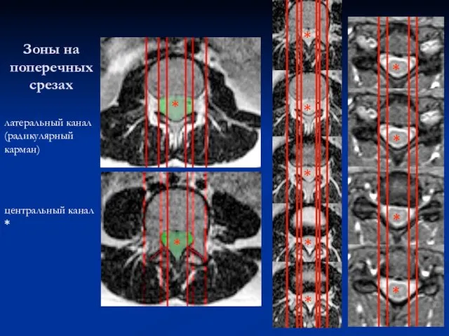 Зоны на поперечных срезах латеральный канал (радикулярный карман) центральный канал * *